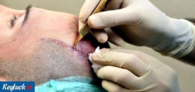 بهترین دکتر کاشت مو در ساری