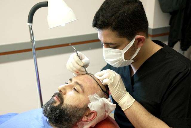 بهترین کلینیک کاشت مو در ساری