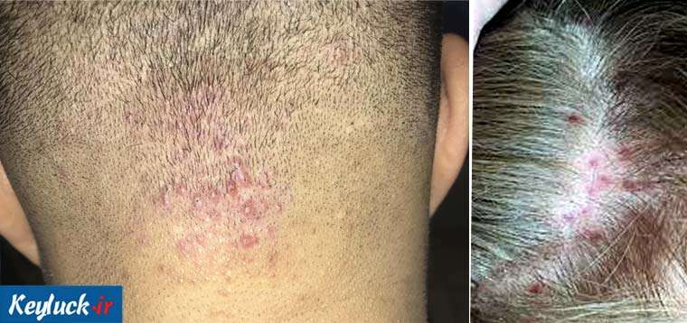 فولیکولیت مو یا Tufted Hair Folliculitis چیست؟
