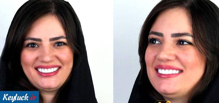 بهترین دکتر کامپوزیت در تهران | تفاوت کامپوزیت با روکش از نگاه متخصص