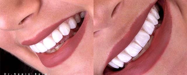 فرق کامپوزیت با روکش چیست؟